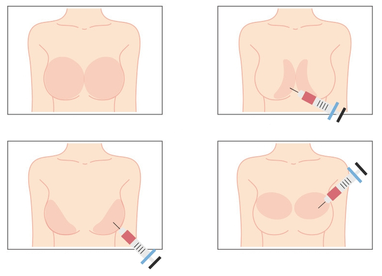 Místa pro injekci kyseliny hyaluronové do prsou