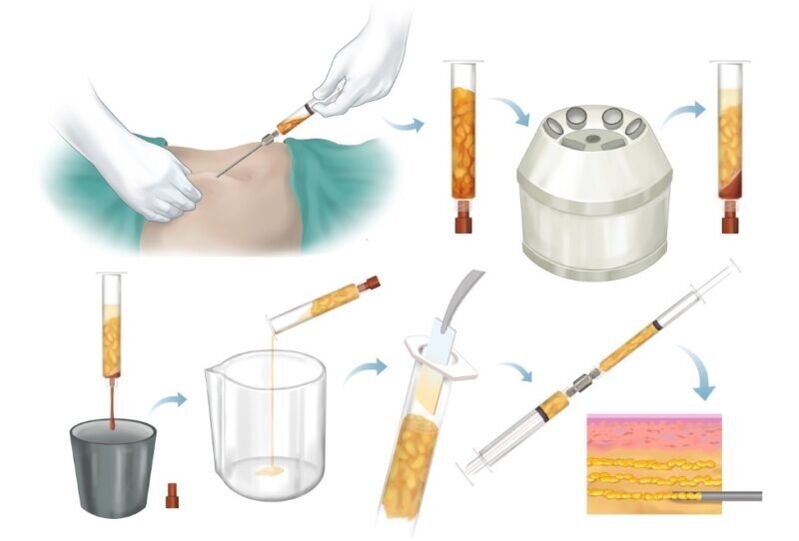 Odstranění tuku z problémových partií, zpracování a vstřikování do prsní tkáně