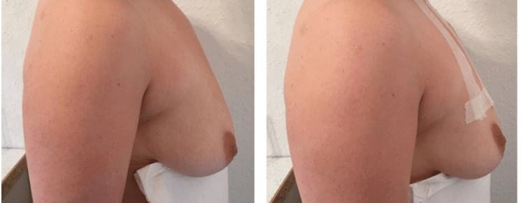 Před a po liftingu nití