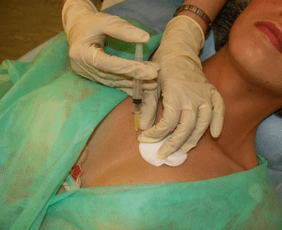 Zavedení meso-koktejlu do prsní tkáně - alternativa injekcí kyseliny hyaluronové